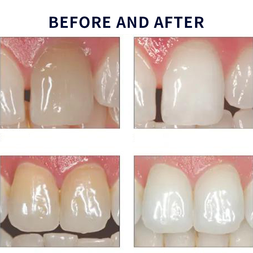 Opalescence Whitening 20% PF 2 - Teeth Whitening Kit recension och pris